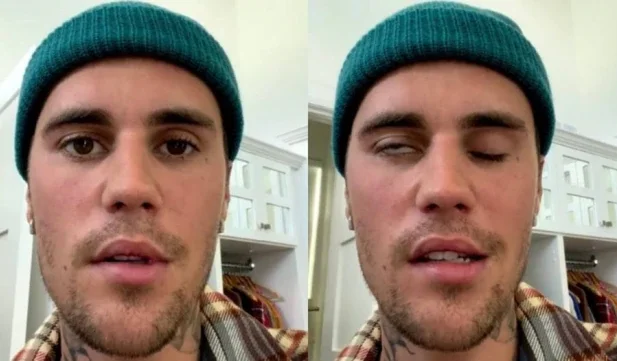 Justin Bieber aparece com metade do rosto paralisado