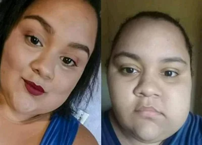 Maria Rita antes e depois do crescimento do cisto