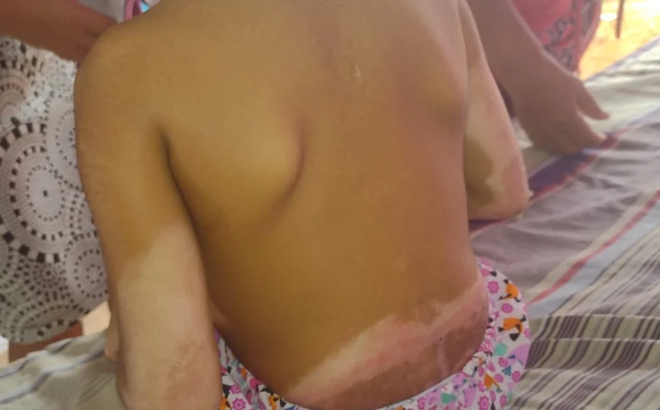 Queimaduras no corpo de Rayssa