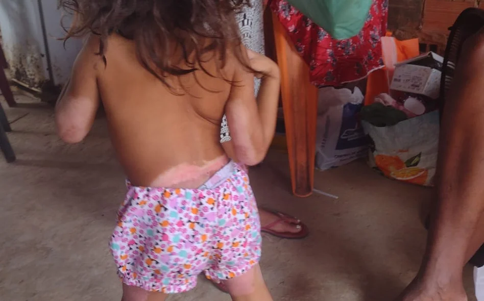 Rayssa teve 36% do corpo queimado