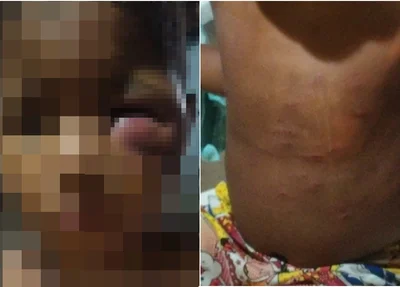Criança de 4 anos ficou com vários hematomas no rosto e no restante do corpo
