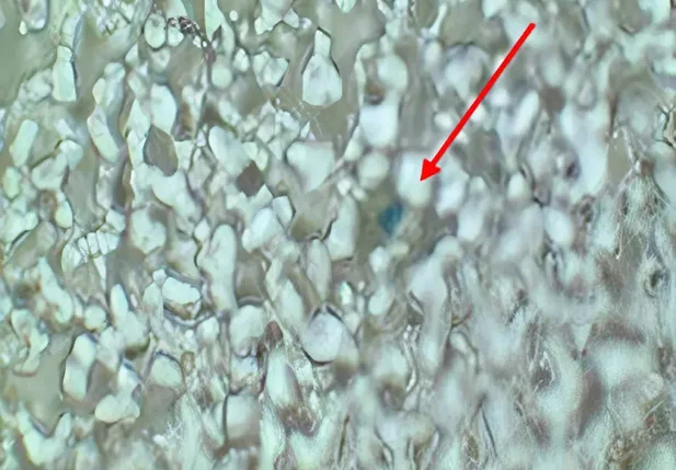 Microplástico detectado em tecido pulmonar humano.