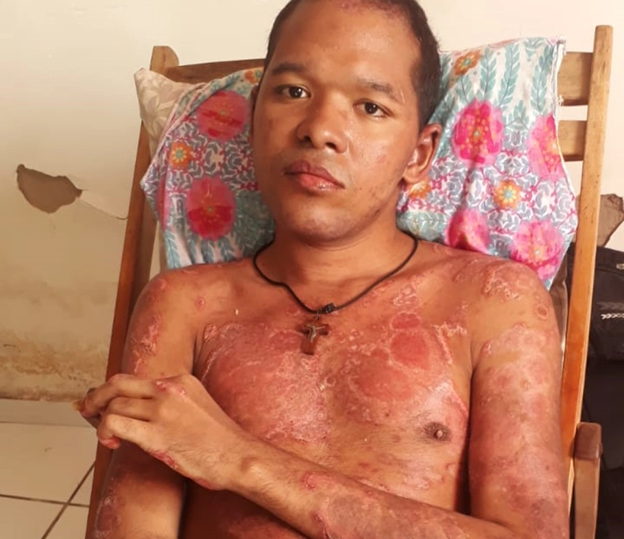 Samuel Ferreira foi diagnosticado com doença agressiva na pele