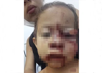 Criança ficou com o rosto bastante machucado