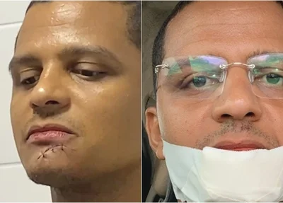 Ismael Silva sofre acidente com facão