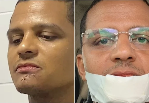 Ismael Silva sofre acidente com facão