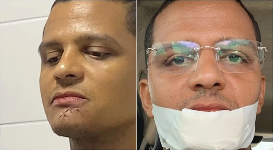 Ismael Silva sofre acidente com facão