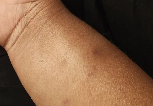 Marca da violência deixada no braço da vereadora