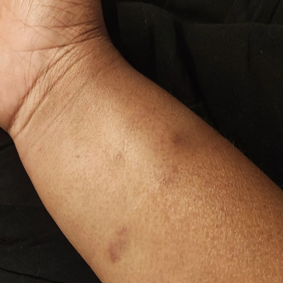 Marca da violência deixada no braço da vereadora