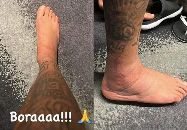 Tornozelo direito de Neymar, lesionado no confronto entre Brasil e Sérvia, na estreia da Copa do Mundo do Catar