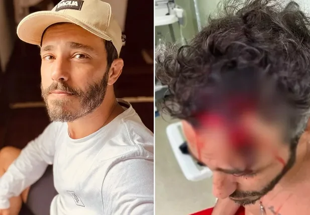 Ator Thiago Rodrigues perdeu parte do couro cabeludo