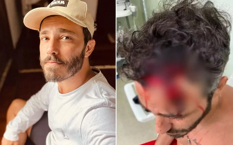 Ator Thiago Rodrigues perdeu parte do couro cabeludo
