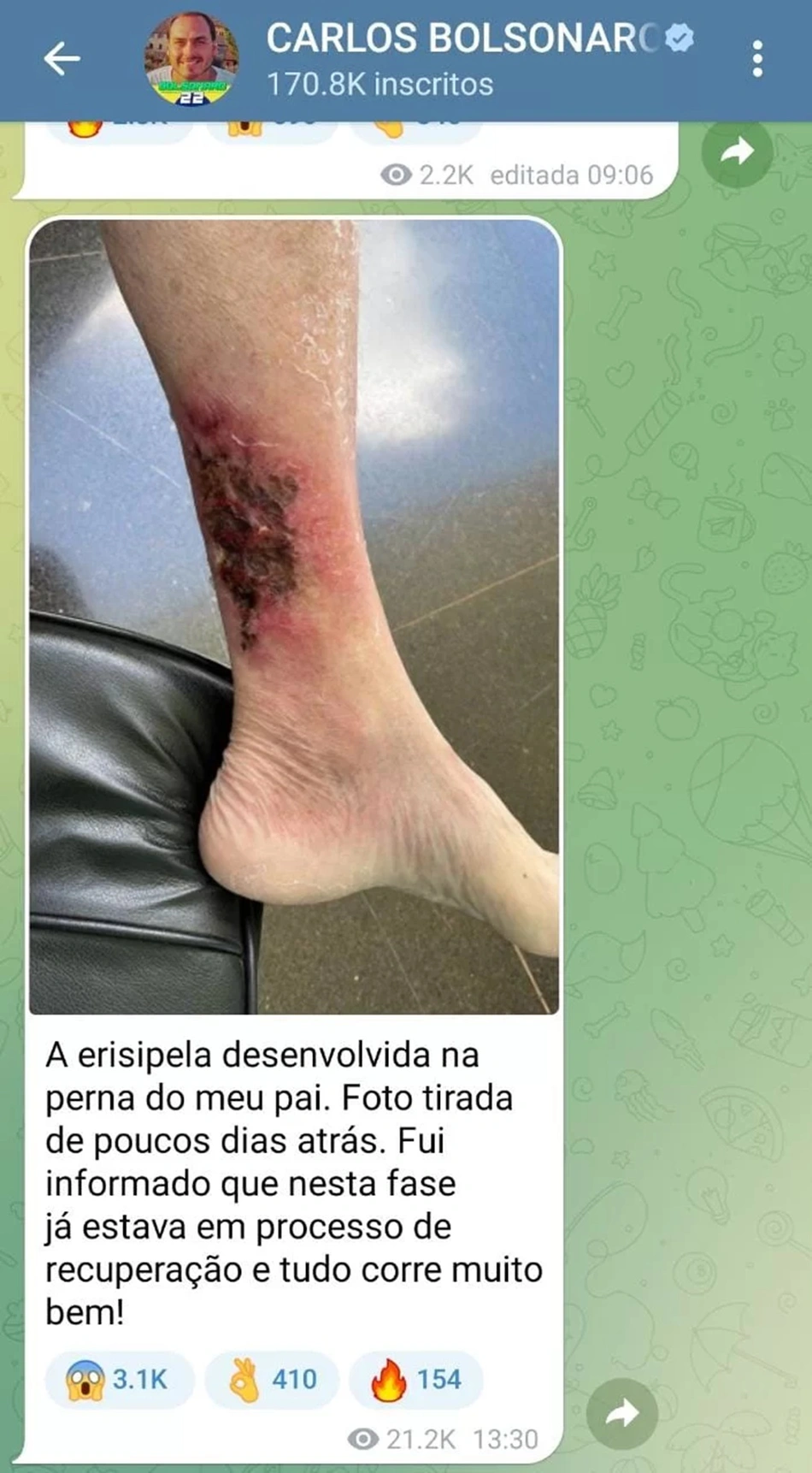 Perna de Jair Bolsonaro com ferimentos devido ao quadro de erisipela