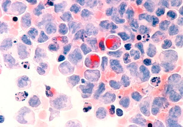 Terapia com células geneticamente modificadas contra câncer