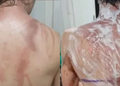 Estudantes exibindo queimaduras