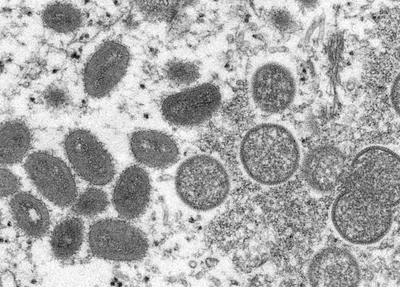 Sinais da varíola dos macacos em uma amostra de pele humana