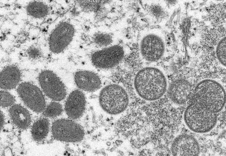 EUA e Europa aceleram vacinação contra varíola dos macacos