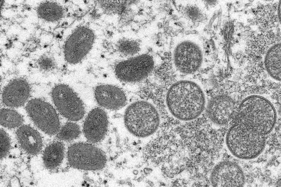 Sinais da varíola dos macacos em uma amostra de pele humana