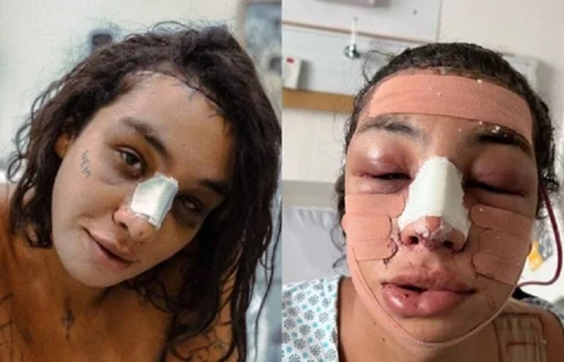 Linn da Quebrada se recupera após cirurgia de feminização facial.