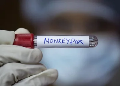 Teste positivo para varíola dos macacos