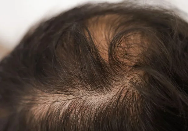 A alopecia, ou calvície, atinge cerca de 80% dos homens depois dos 60 anos e até 60% das mulheres na mesma faixa etária
