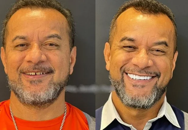 Luiz Carlos das Dores, de 56 anos, após fazer as facetas dentárias