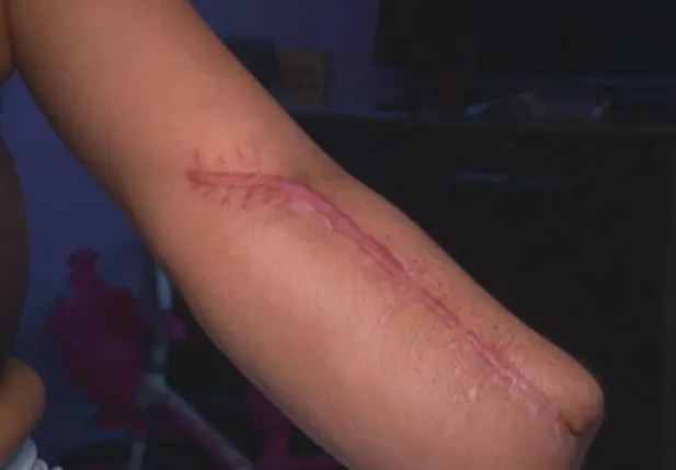 Mulher dá entrada em hospital do RJ para dar à luz e sai com mão amputada