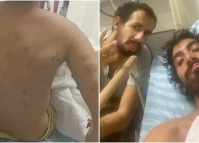 Brasileiro atingido por estilhaços está internado.