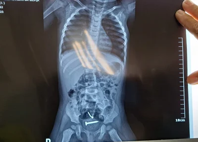 Dentro da criança havia prego e parafuso