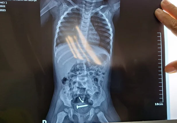 Dentro da criança havia prego e parafuso