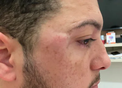 Marcas da agressão em Fabrício Rocha