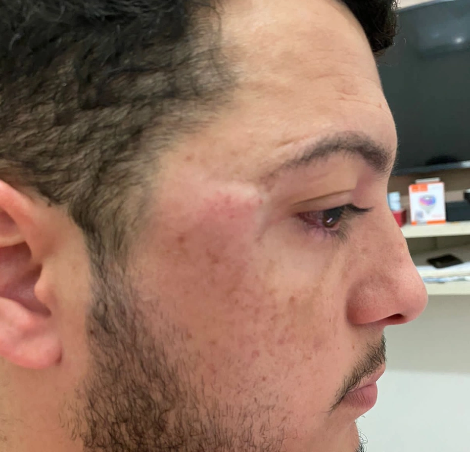 Marcas da agressão em Fabrício Rocha