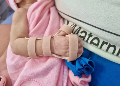 Nova Maternidade Dona Evangelina Rosa produz órteses para  bebês prematuros