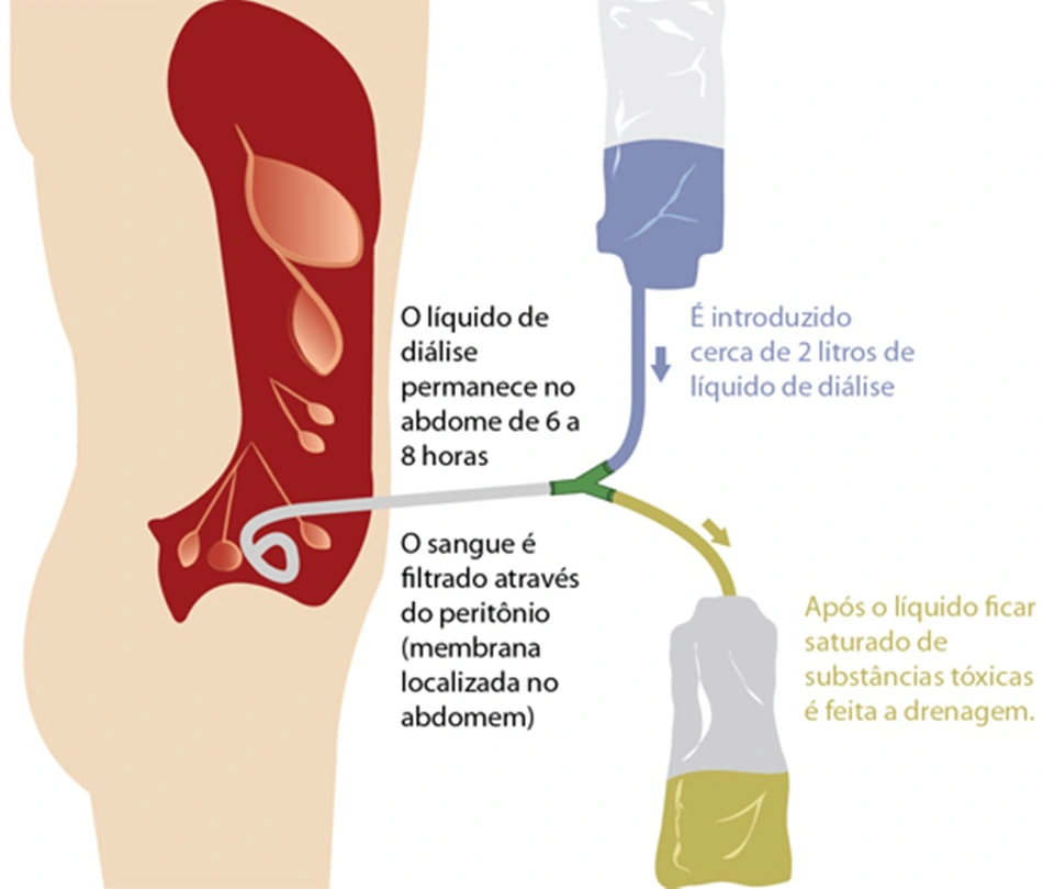 Procedimento de diálise peritoneal