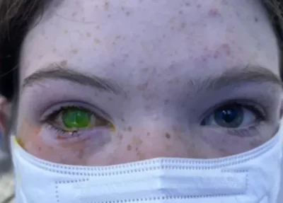 Doença que muda a cor do olho causa alerta na Austrália