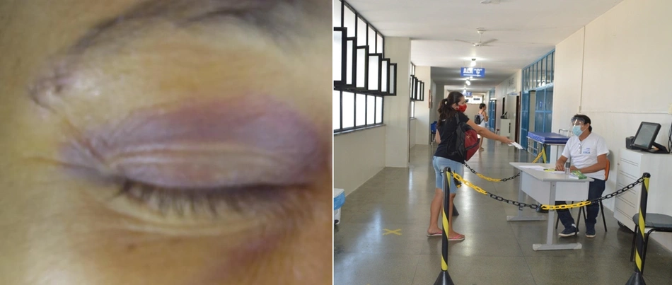 A vítima teve o supercílio cortado após sofrer agressão no Lineu Araújo