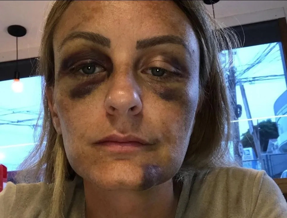 Surfista norte-americana Sara Taylor após agressão