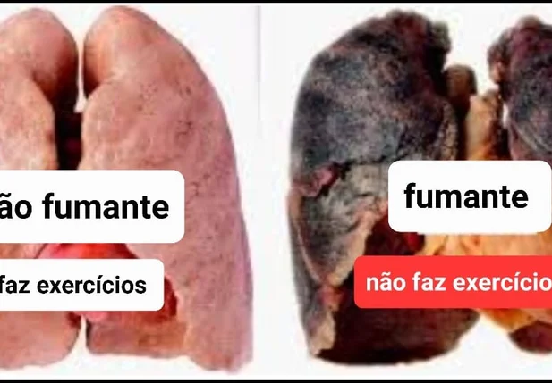 Imagem de um pulmão de uma pessoa que não fuma e de uma pessoa que fuma