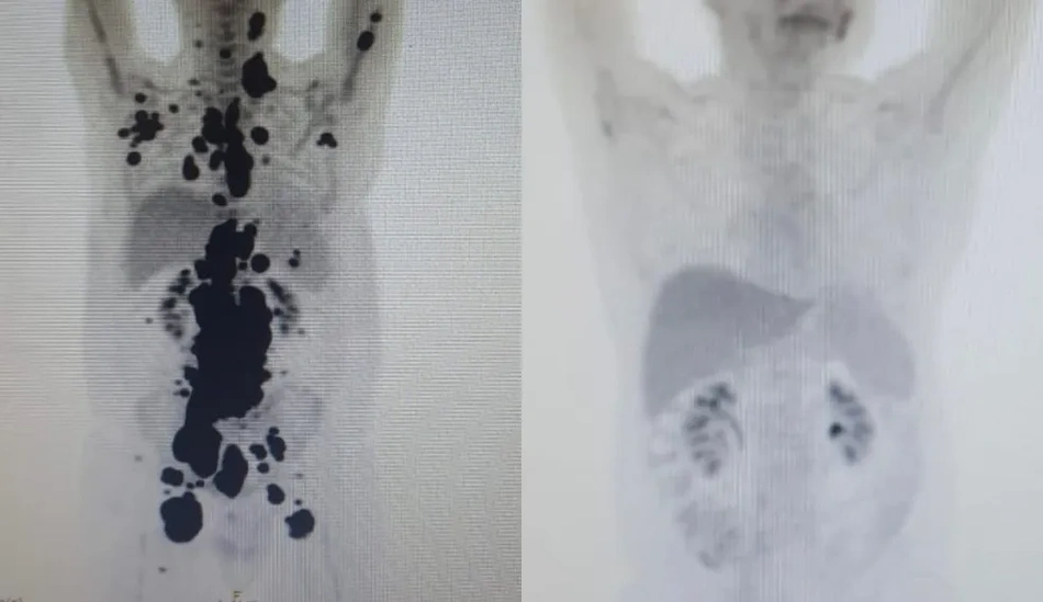 Imagens mostram antes e depois da doença em paciente com câncer