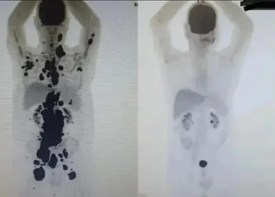 A primeira imagem mostra o câncer espalhado em seu corpo, já a segunda mostra a sua remissão completa