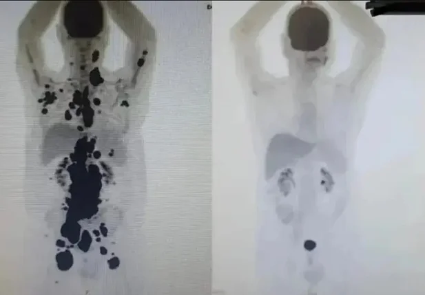 A primeira imagem mostra o câncer espalhado em seu corpo, já a segunda mostra a sua remissão completa