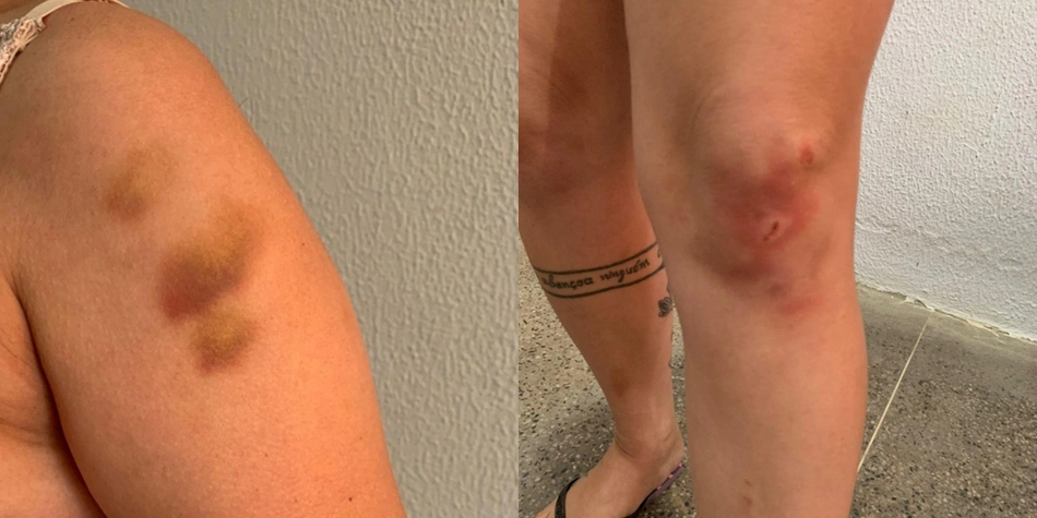 Vítima ficou com vário hematomas