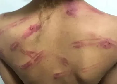Marcas das agressões na adolescente