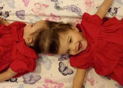 As gêmeas siamesas Allana e Mariah foram separadas após cirurgia que teve 25 horas de duração