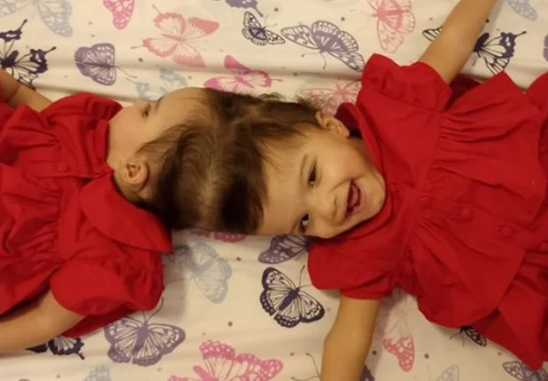 As gêmeas siamesas Allana e Mariah foram separadas após cirurgia que teve 25 horas de duração