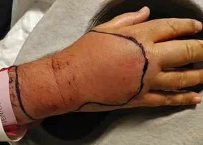 Homem foi mordido por um gato de rua