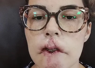 Mulher perde lábio após preenchimento estético com PMMA