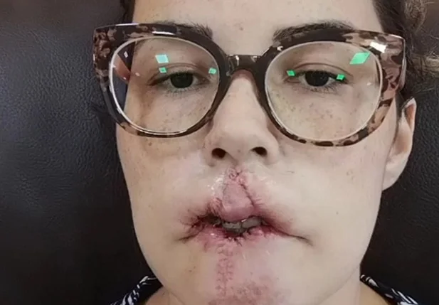 Mulher perde lábio após preenchimento estético com PMMA