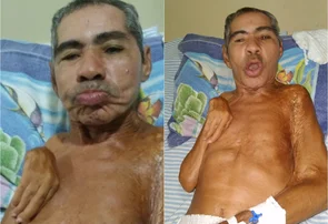 Idoso sofre queda em Picos e precisa de ajuda para fazer cirurgia