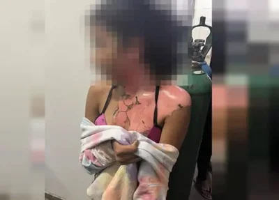 Vítima foi queimada com água quente pela tia no DF